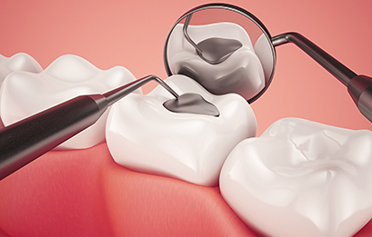 Dental Crowns and Bridges