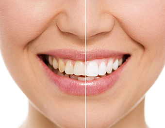 mississauga teeth whitening