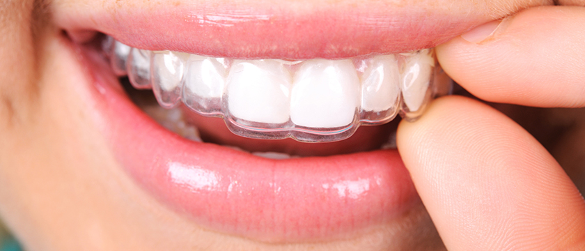 Invisalign in Mississauga,