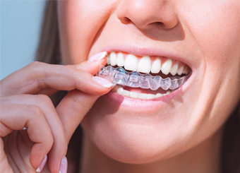 A Complete Guide to Invisalign