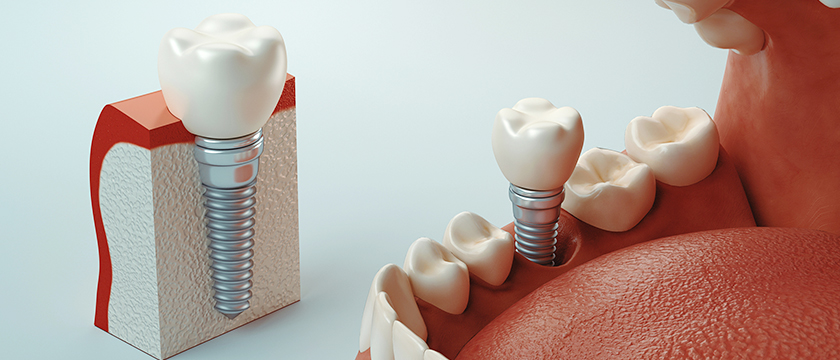 A Complete Guide to Dental Implants