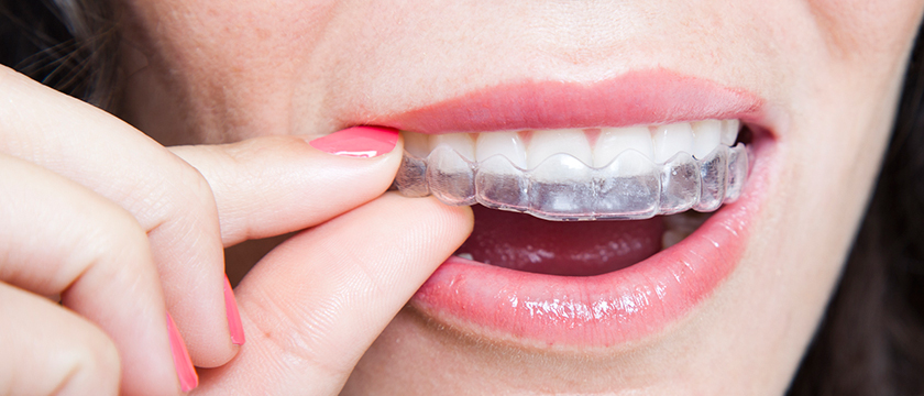 Important Questions to Ask Your Dentist About Invisalign