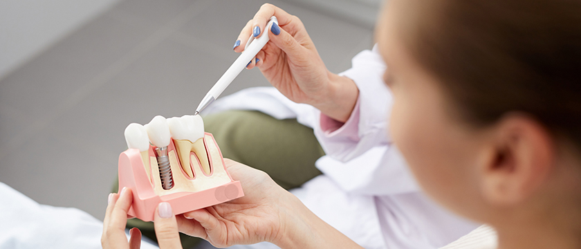 Should You Look into Getting a Dental Implant?