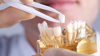 Who Should Get a Dental Implant?