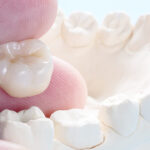How a Dental Crown Can Help Improve Your Smile
