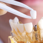 Recover from a Dental Implant Procedure Faster