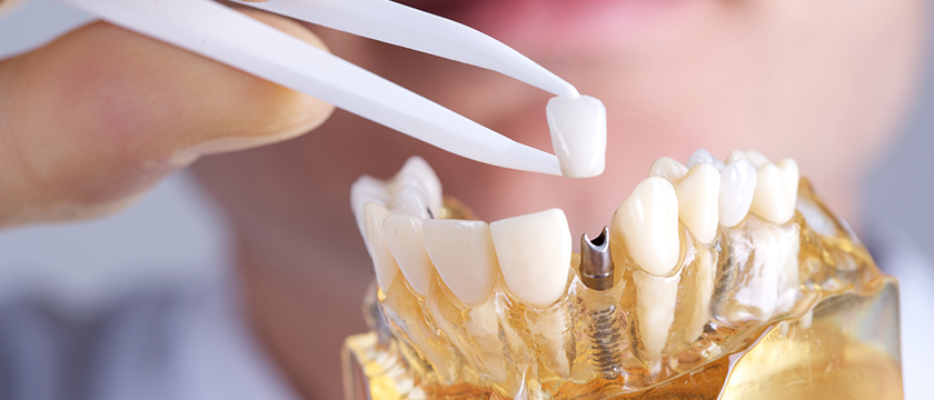 Recover from a Dental Implant Procedure Faster