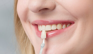 10 Benefits of Veneers for Improving Your Oral Health