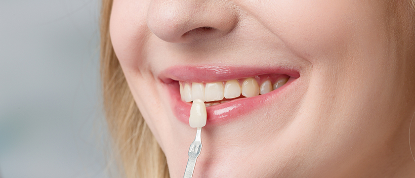 How Veneers Can Improve Your Oral Health