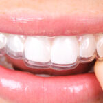 10 Things You Should Know About Invisalign