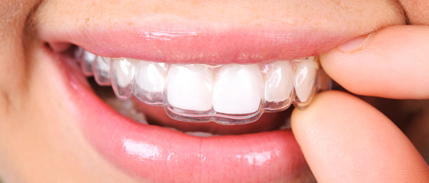 10 Things You Should Know About Invisalign