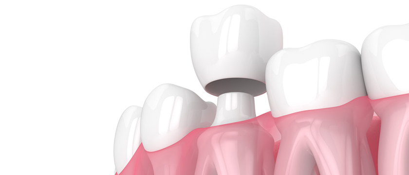 Various Tooth Problems Can Solve with Dental Crown