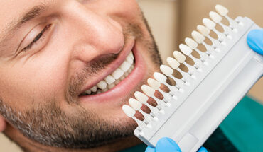 8 Frequently Asked Questions about Composite Veneers