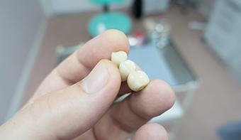 A Complete Guide to Dental Bridges