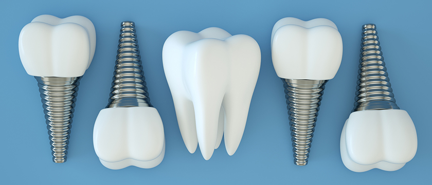 Debunking 15 Myths About Dental Implants