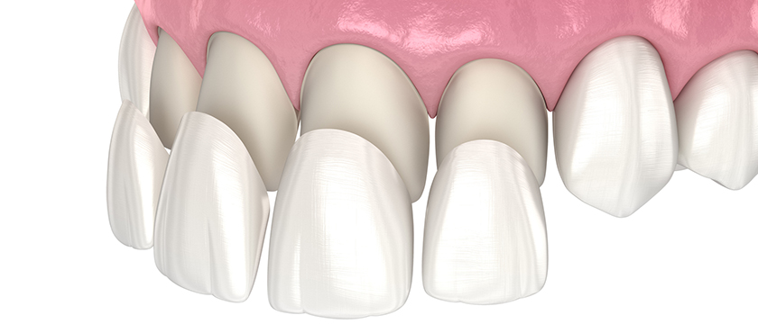 Your Personal Guide to Dental Veneers