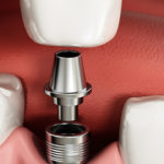 Important Things to Know Before a Dental Implant Procedure