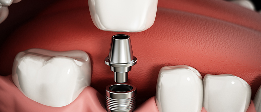 Important Things to Know Before a Dental Implant Procedure