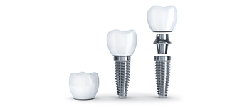 Things You Need to Know Before Opting for Dental Implants