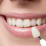 How to Care for Your Dental Veneers