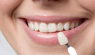 How to Take Care of Your Dental Veneers