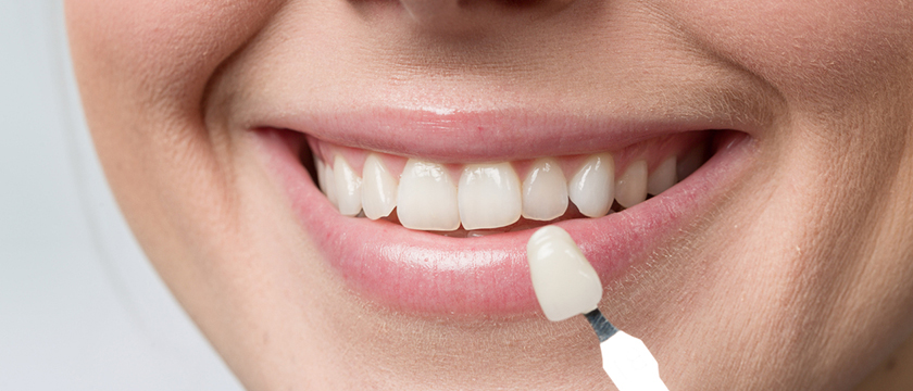 How to Care for Your Dental Veneers