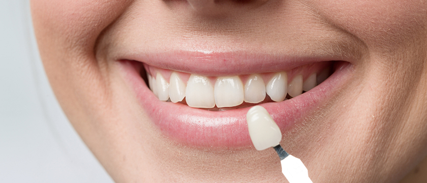 How to Care for Your Dental Veneers