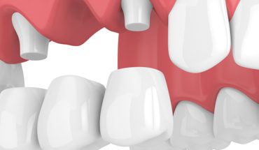 When Does a Dentist Recommend a Dental Bridge: Beginner’s Guide
