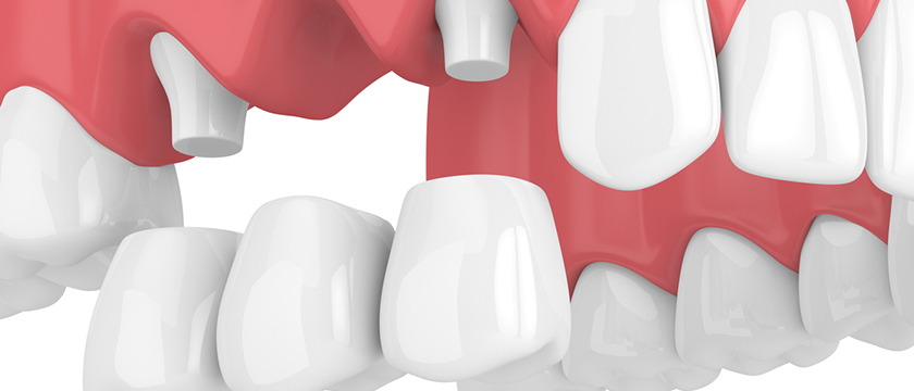 When Is the Best Time to Get a Dental Bridge