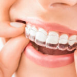 Guide to Using Invisalign Chewies
