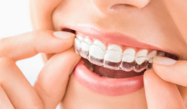 Your Complete Guide to Invisalign Chewies