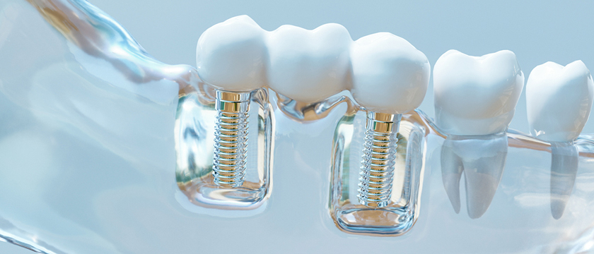 15 Unique Questions About Dental Implants