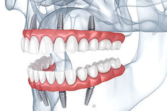 15 Things You Didn’t Know About Dental Implants