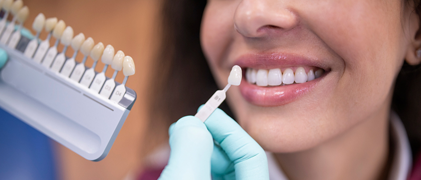 Composite Veneers vs. Porcelain Veneers: Differences You Should Know