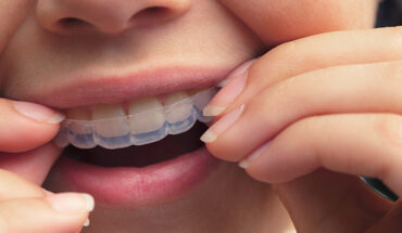 How to Prepare for Invisalign Treatment in Canada