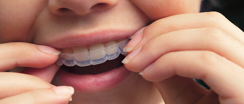 How to Prepare for Invisalign Treatment in Canada