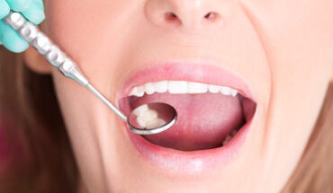 Things You Should Know Before Getting a Dental Filling