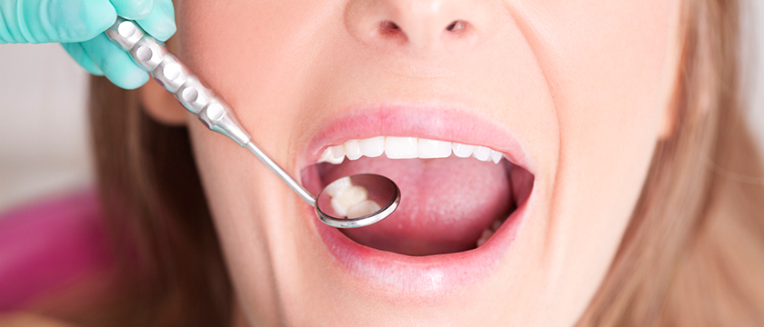 Things You Should Know Before Getting a Dental Filling