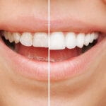 Your Complete Guide to Composite Veneers