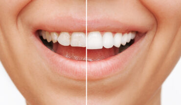 Your Complete Guide to Composite Veneers