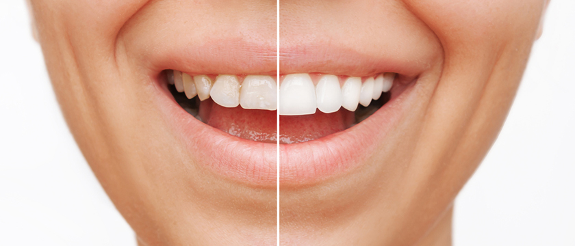 Your Complete Guide to Composite Veneers