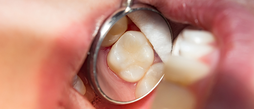 Are Dental Fillings Safe?