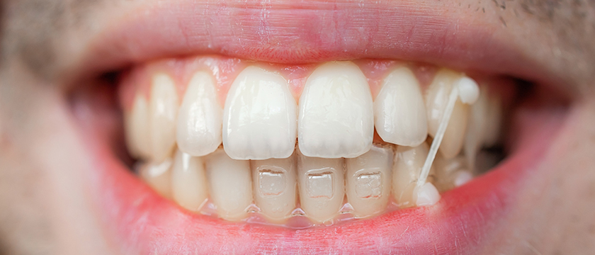 What are Invisalign Rubber Bands?