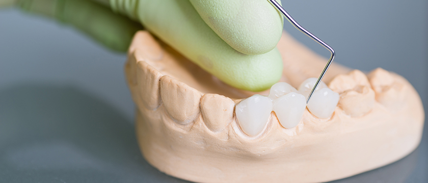 How to Care for Your Dental Bridge Easily