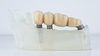 Professional Dental Bridge Services at Trillium Smile Dentistry