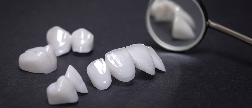 Factors to Consider for Dental Veneers