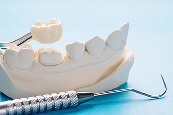 Cost of dental crowns