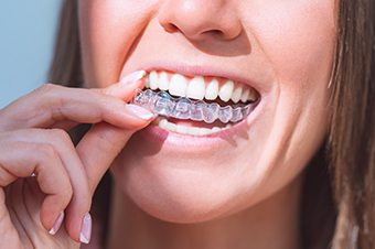 Invisalign Mississauga