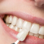 Your Complete Maintenance Guide for Veneers