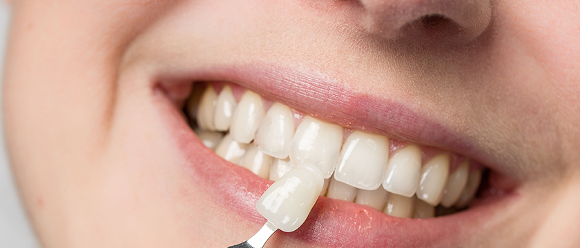 Your Complete Maintenance Guide for Veneers